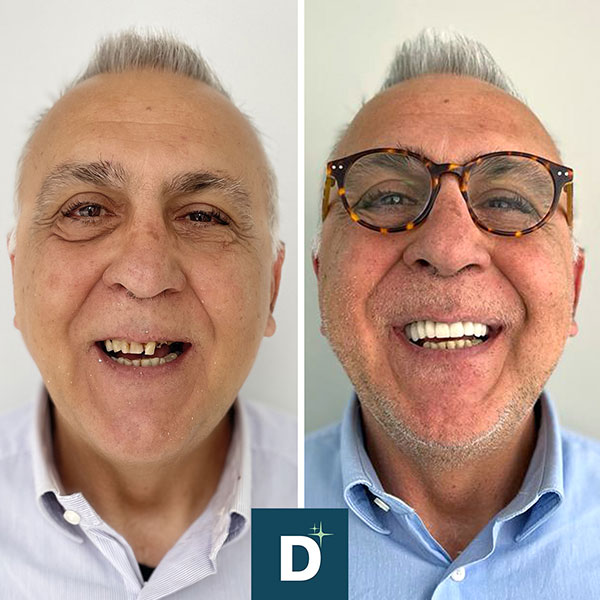 Denti_a_Vita_Dentisti_in_Albania_Turismo_Dentale_Prima_Dopo_01
