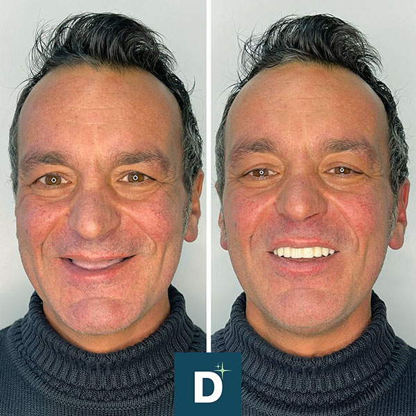 Denti_a_Vita_Dentisti_in_Albania_Turismo_Dentale_Prima_Dopo_02