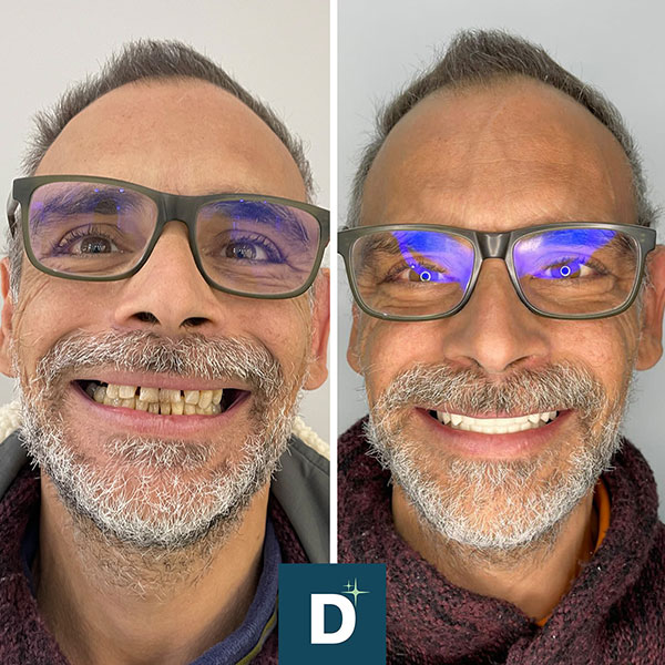 Denti_a_Vita_Dentisti_in_Albania_Turismo_Dentale_Prima_Dopo_04