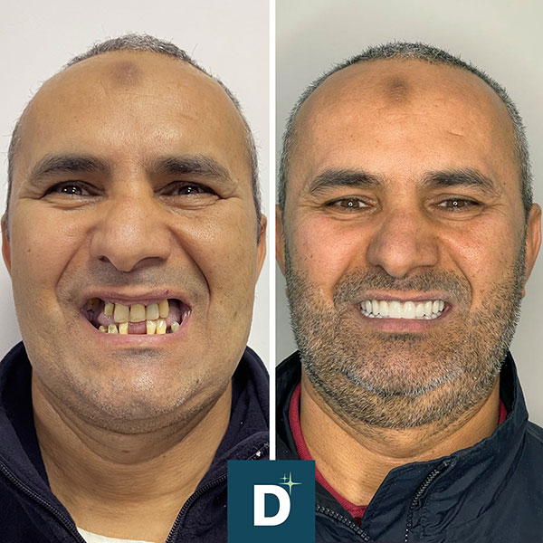 Denti_a_Vita_Dentisti_in_Albania_Turismo_Dentale_Prima_Dopo_05