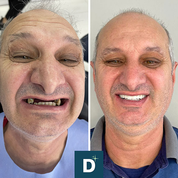 Denti_a_Vita_Dentisti_in_Albania_Turismo_Dentale_Prima_Dopo_06