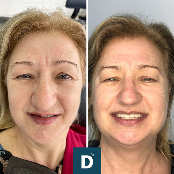 Denti_a_Vita_Dentisti_in_Albania_Turismo_Dentale_Prima_Dopo_08