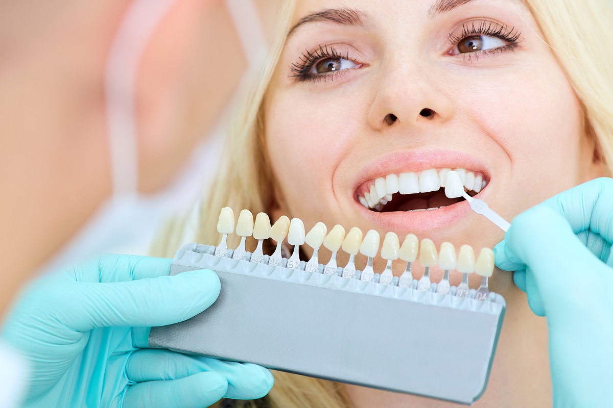 come modificare la forma dei denti