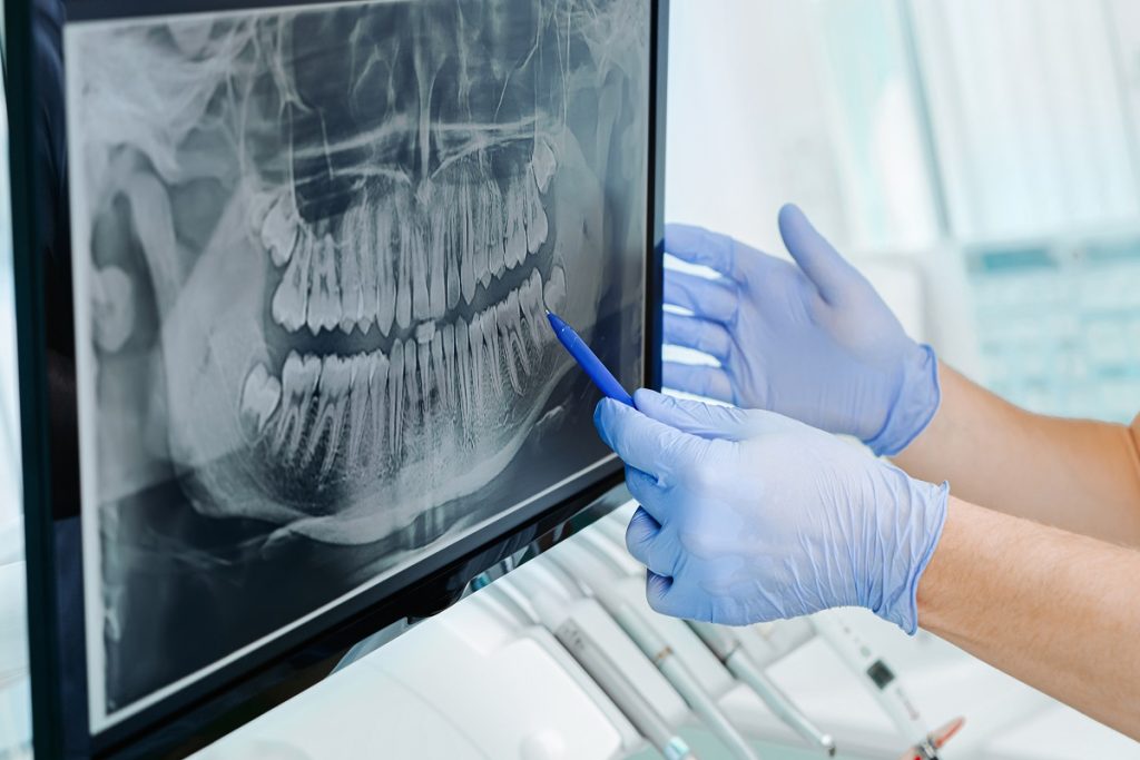 radiografia dentale a cosa serve