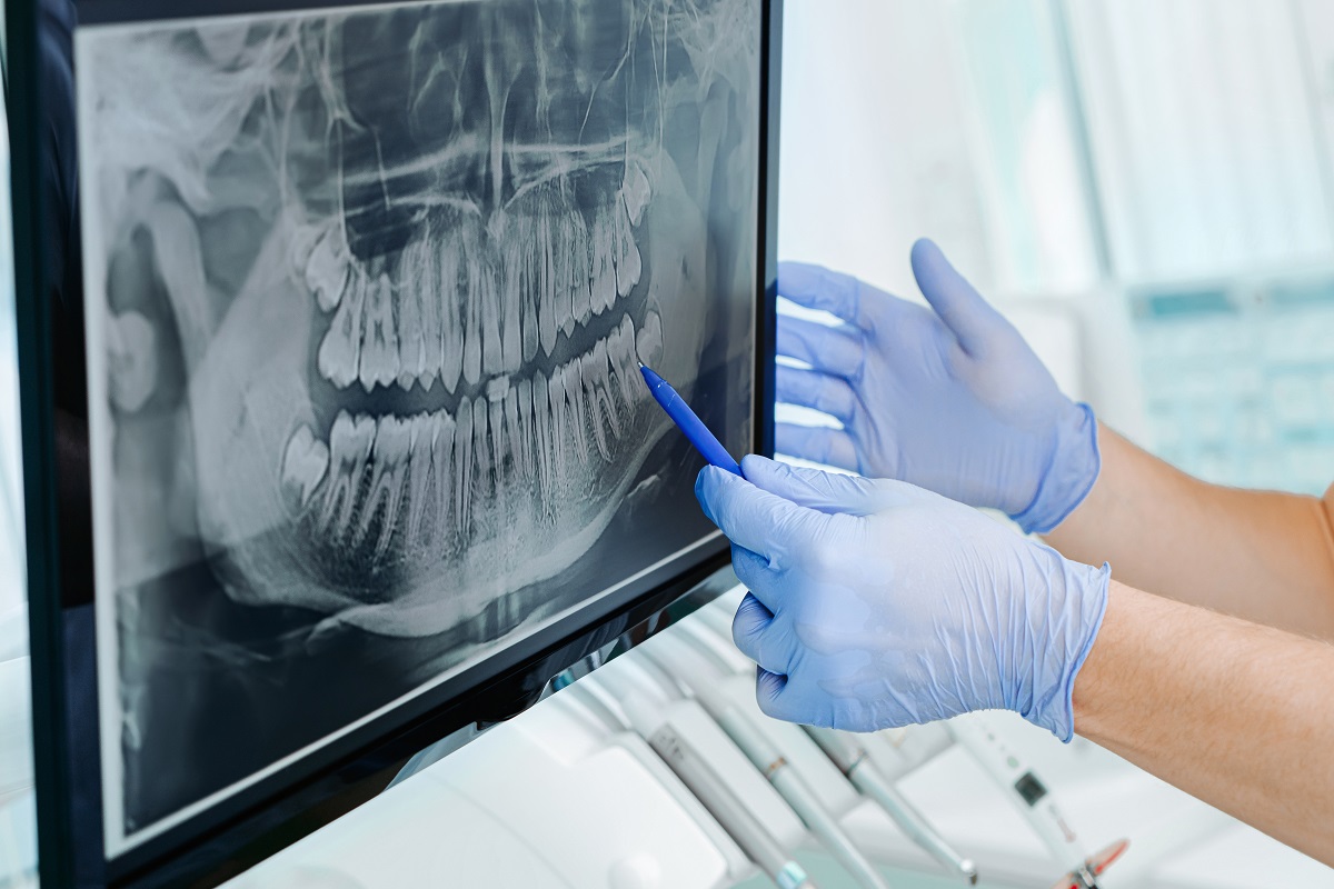 radiografia dentale a cosa serve