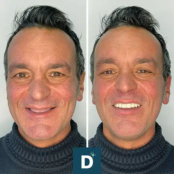 Denti_a_Vita_Dentisti_in_Albania_Turismo_Dentale_Prima_Dopo_02